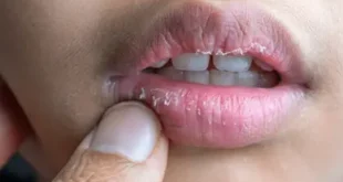 Alt text Dry lips