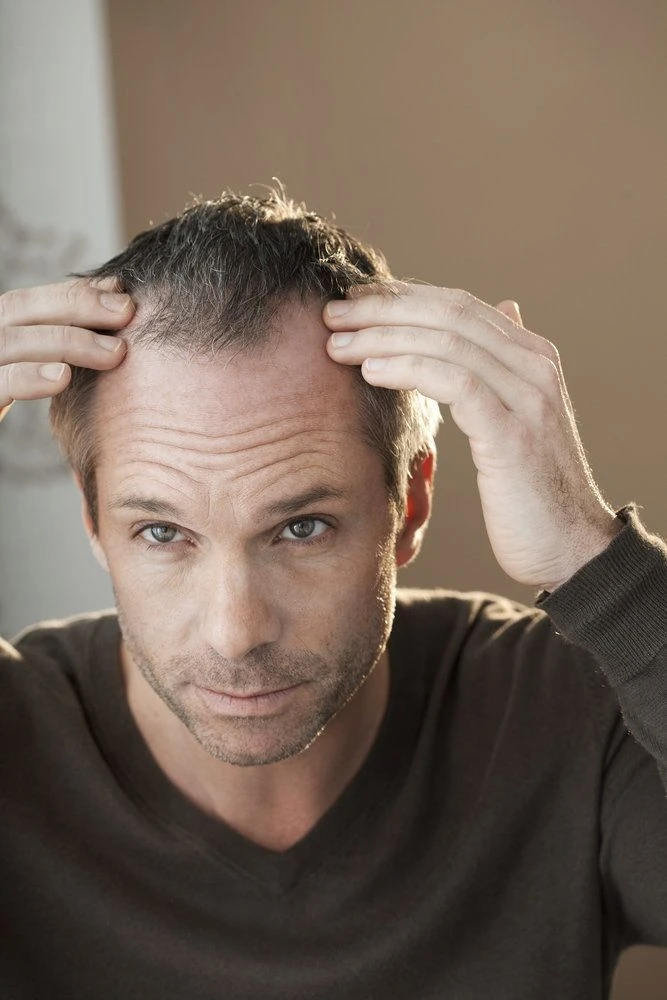 Alt text hair loss